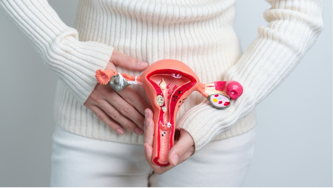 Pcos image