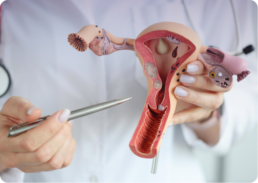 endometriosis image